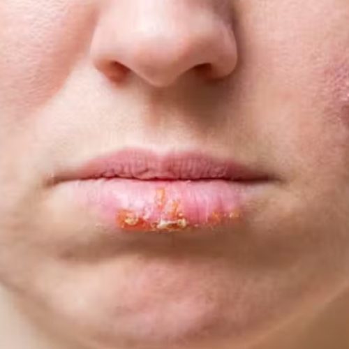 Herpes: novo medicamento que inativa o virus é mais eficaz que aciclovir